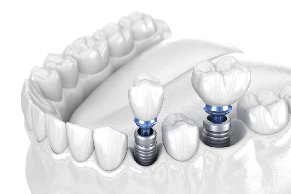 Premolar and Molar tooth crown installation