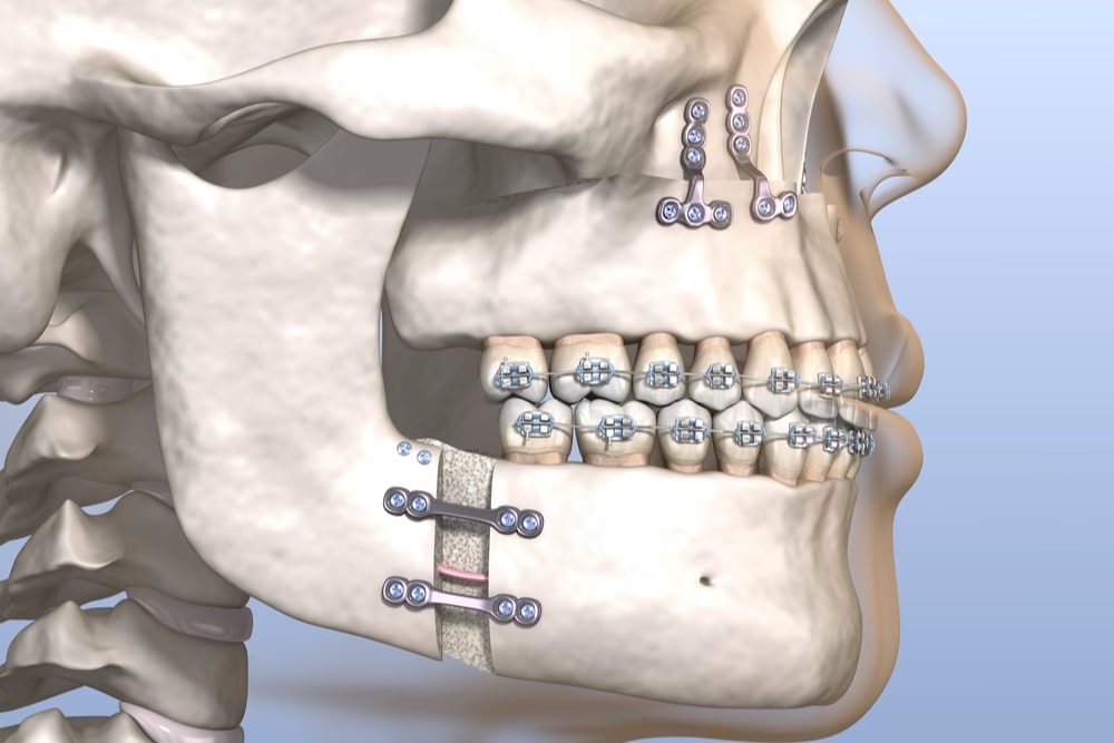 Corrective Jaw Surgery San Diego West Coast Oral Surgery